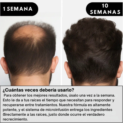 Sistema de regeneración capilar Infustrand™